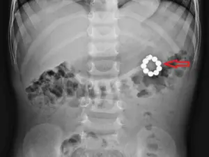 '복통 3일째' 다섯 살 아이 개복해보니…위에서 대장까지 뚫은 자석 구슬 발견